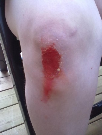 Aj! Cyckelolycka eller? 